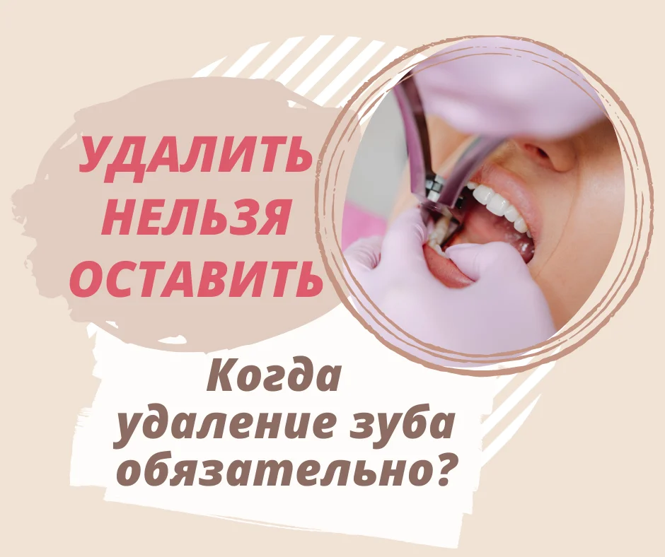 Когда удаление зуба обязательно?