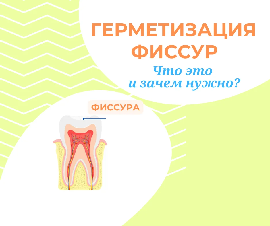 Герметизация фиссур. Что это и зачем нужно?