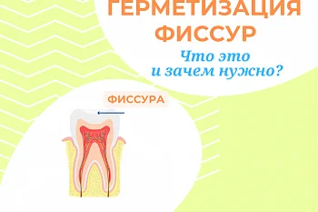 Герметизация фиссур. Что это и зачем нужно? Герметизация фиссур. Что это и зачем нужно?